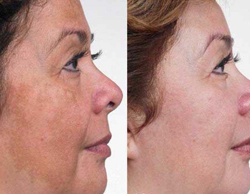 SKIN BRIGHTENING SET - GET VISIBLY FAIR SKIN IN JUST 3 WEEKS