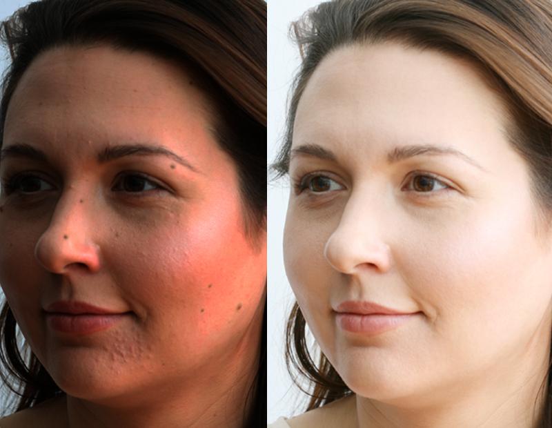 SKIN BRIGHTENING SET - GET VISIBLY FAIR SKIN IN JUST 3 WEEKS