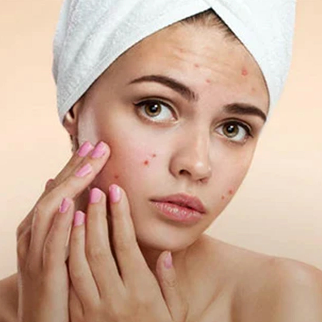 Acne Treatment Vaadi Organics South Africa acne-treatment-vaadi-organics-south-africa