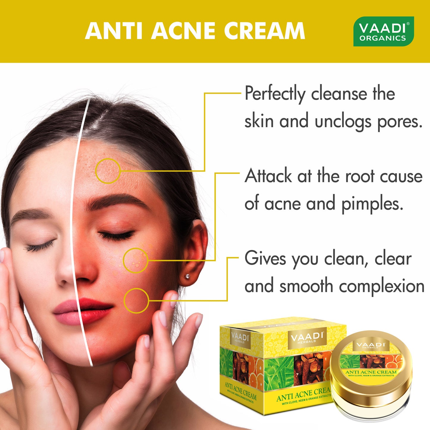 Anti Acne Organic Cream with Clove Oil & Neem Extract - Anti Bacterial Therapy - Controls Excess Oil - Prevents Acne (3 x 30 gms / 1.1 oz)